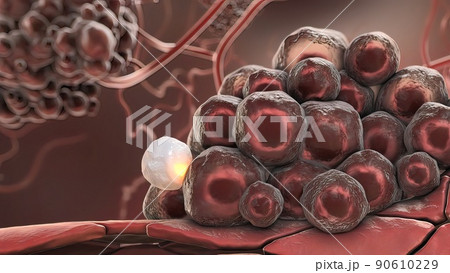 3D illustration Activated Cancer Cells, Growing Tumors 90610229