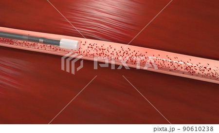 Vascular occlusion is a blockage of a blood vessel, usually with a clot. 90610238