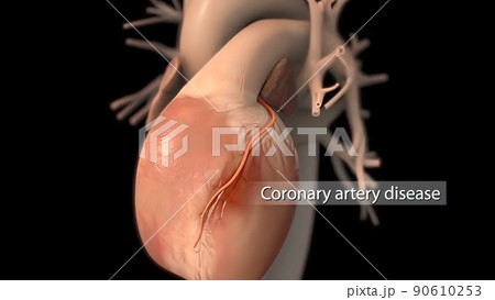 Carotid Artery Disease 3D Medical illustration 90610253