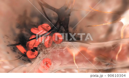 Cerebral hemorrhage as a result of an aneurysm bursting in the brain 90610304