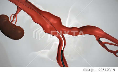 balloon angioplasty procedure with stent in vein 90610319