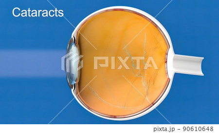 Cataract, clouding of the lens of the eye that causes decreased vision. 90610648