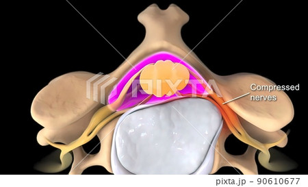 Breaking of the deformed disc and putting pressure on the nerve 90610677