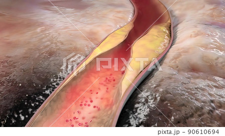 Clogging of the arteries with plaque 90610694