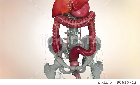 3D Medical of colon cancer. Tumor growth 90610712