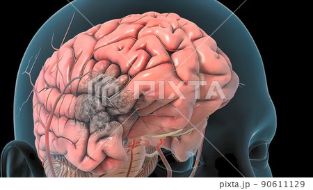 Cerebral hemorrhage as a result of an aneurysm bursting in the brain Cerebral hemorrhage as a result of an aneurysm bursting in the brain 90611129