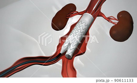 balloon angioplasty procedure with stent in veinのイラスト素材 [90611133] - PIXTA