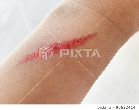 Close up of burn scar on a woman's hand. The skin damage in first-degree on outer layer skin.  90622414