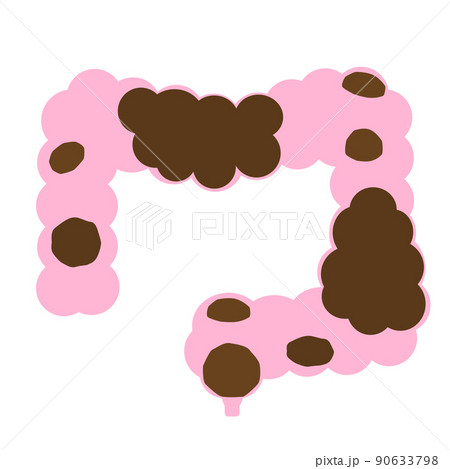 便秘のイメージ。不健康な腸内に溜まったウンチ。 90633798