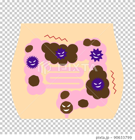 Image of constipation. A poop that collects in an unhealthy intestine. 90633799