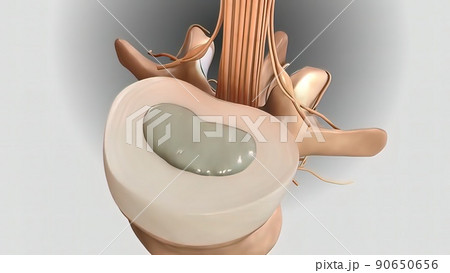 3D illustration of the destruction of discs and compression of nerve 3D illustration of the destruction of discs and compression of nerve 90650656