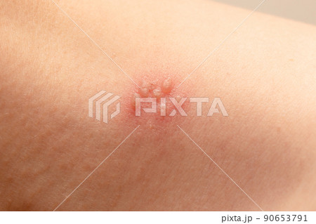 毛虫に刺された肌 90653791