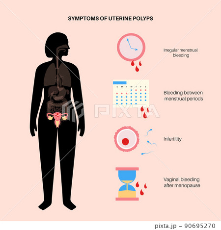 Uterus Polyps Disease 90695270