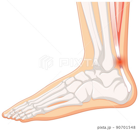 Achilles tendo rupture on white background Achilles tendo rupture on white background 90701548