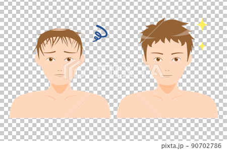 AGA Thinning Hair Alopecia Male Before After AGA Thinning Hair Alopecia Male Before After 90702786