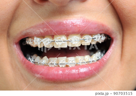 Close-up of ceramic and metallic braces on teeth. Orthodontic Treatment. Dental Care 90703515
