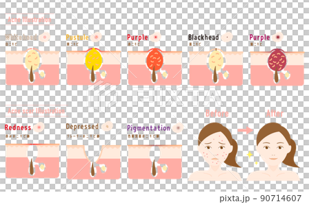 ニキビとニキビ跡 皮膚断面図 女性のビフォーアフター 90714607