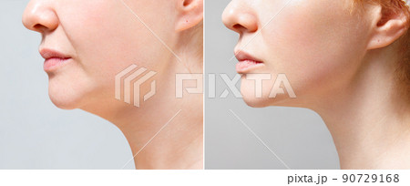 A close portrait of an aged woman before and after facial rejuvenation procedure. Correction of the chin shape liposuction of the neck. The result of the procedure in the clinic of aesthetic medicine. 90729168