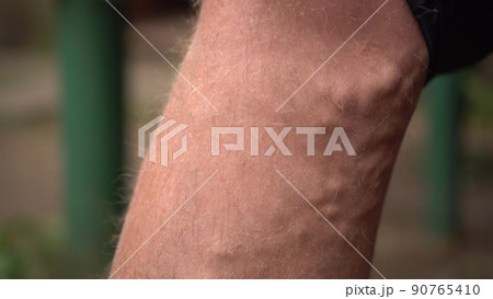 Close-up of varicose veins and age spots on a human leg. 90765410