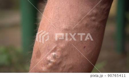 Close-up of varicose veins and age spots on a human leg. Close-up of varicose veins and age spots on a human leg. 90765411