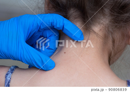 Birthmark on child neck 90806839
