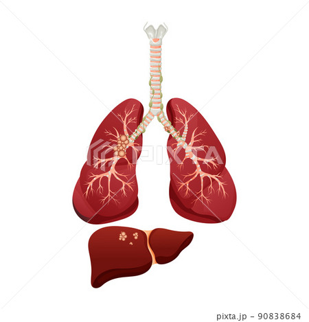 Diagram lung cancer disease. Concept disease human internal organs. Vector illustration, cartoon style. 90838684