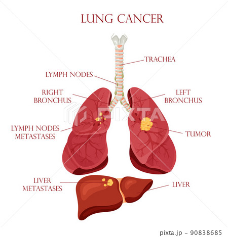 Diagram lung cancer disease. Concept disease human internal organs. Vector illustration, cartoon style. 90838685