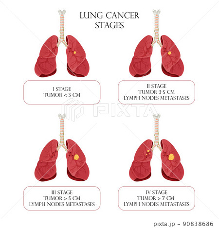 Lung cancer stages. Concept diseases human internal organs. Cartoon style, vector illustration. 90838686