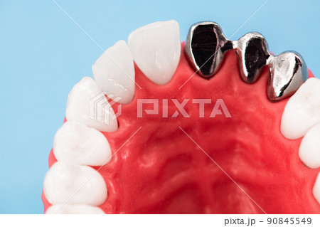 Teeth implant and crown installation process parts isolated on a blue background. Medically accurate 3D model.  90845549