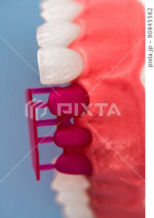 Teeth implant and crown installation process parts isolated on a blue background. Medically accurate 3D model.  90845562