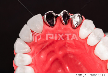 Teeth implant and crown installation process parts isolated on a blue background. Medically accurate 3D model.  90845614