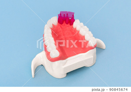 Teeth implant and crown installation process parts isolated on a blue background. Medically accurate 3D model. Teeth implant and crown installation process parts isolated on a blue background. Medically accurate 3D model. 90845674