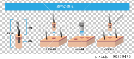 毛髮移植流程（AGA / 稀疏毛髮治療 / 髮根 / 毛囊 / 毛髮移植） 90859476