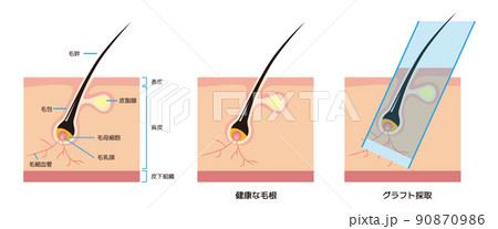 毛根の断面解剖図と薄毛・AGAの自毛植毛 90870986