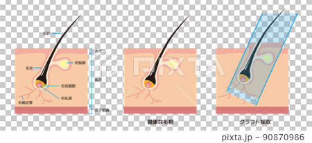 髮根和稀疏頭髮的橫截面解剖 / AGA 自己的頭髮移植 90870986