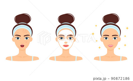 Young woman with acne. Treatment, before and after skincare. Face mask, beauty concept, vector illustration 90872186