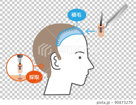 Hair transplantation / transplantation method (graft collection / implant) 90873270