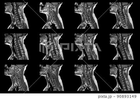 set of sagittal MRI scans of neck area of caucasian male with bilateral paramedial extrusion of the C6-C7 segment with radiculopathy set of sagittal MRI scans of neck area of caucasian male with bilateral paramedial extrusion of the C6-C7 segment with radiculopathy 90893149