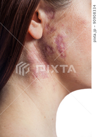 woman with real port-wine stain birthmark on her face, isolated on white background.  90908334
