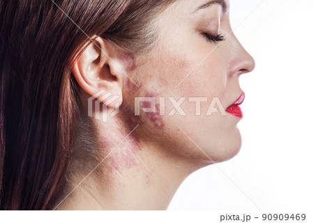 woman with real port wine stain birthmark on her face, isolated on white background.  90909469