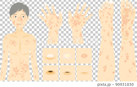 猴痘皮膚症狀和狀況變化的圖像 面部、身體、手和腳、傳染病病毒 90931830