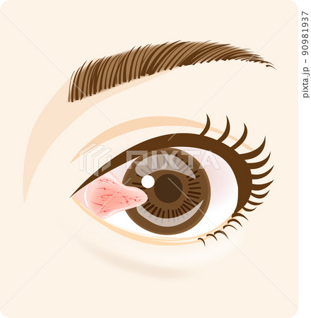 翼状片(目頭) 90981937