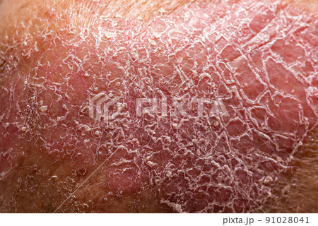 Psoriasis is the abdomen on white background. 91028041