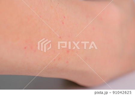 腕に出た赤い湿疹 紅斑丘疹 皮膚炎 腕に出た赤い湿疹 紅斑丘疹 皮膚炎 91042625
