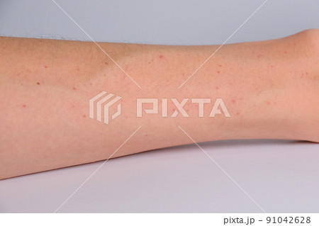 腕に出た赤い湿疹　紅斑丘疹　皮膚炎 91042628