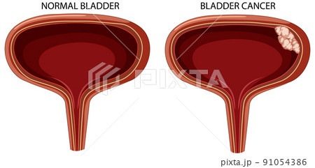 Stage of bladder cancer 91054386