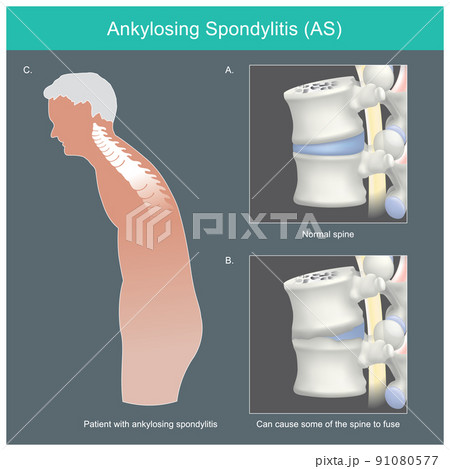 Ankylosing spondylitis. Human spine deformities from inflammation and can cause some of the spine to fuse. 91080577
