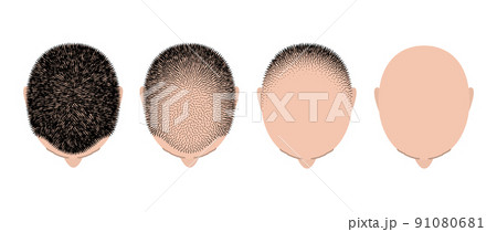 Hair loss bald head alopecia transplant growth vector top view. Hair loss men top view alopecia Hair loss bald head alopecia transplant growth vector top view. Hair loss men top view alopecia 91080681