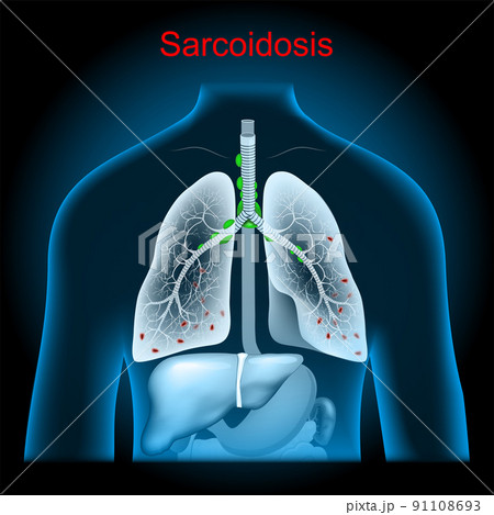Sarcoidosis. Enlarged lymph nodes in the lungs Sarcoidosis. Enlarged lymph nodes in the lungs 91108693