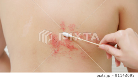 man with shingles disease man with shingles disease 91143095